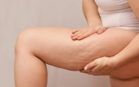 Como prevenir y eliminar la Celulitis